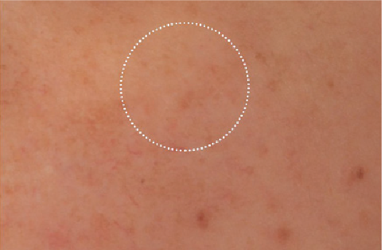 Pigmented lesions after diode laser treatment